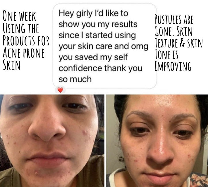 Acne Healing Facial Oil | Acne Prone Skin Care | Proprietary Healing Herbal Blend